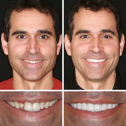⏰Ends Today: 70% OFF!  Custom-Fit — Designed for Comfort and a Natural-Looking Smile